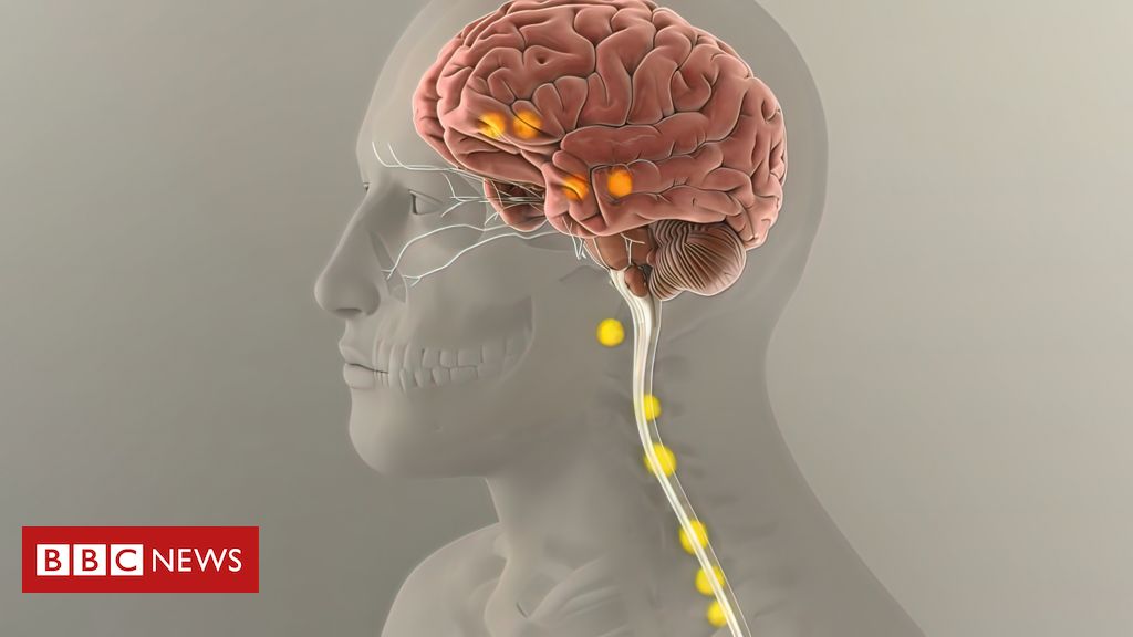 como-funciona-implante-para-tratar-depressao-resistente-que-sera-aplicado-pela-1a-vez-no-brasil